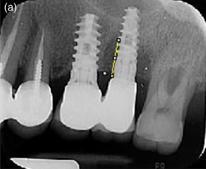 Fig. 2 (a) : Radiographie périapicale prise avant le traitement.