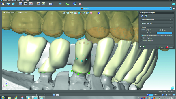 Adaptation of traditional working methods to the creation of Cr-Co ceramic restoration with CAD/CAM technology