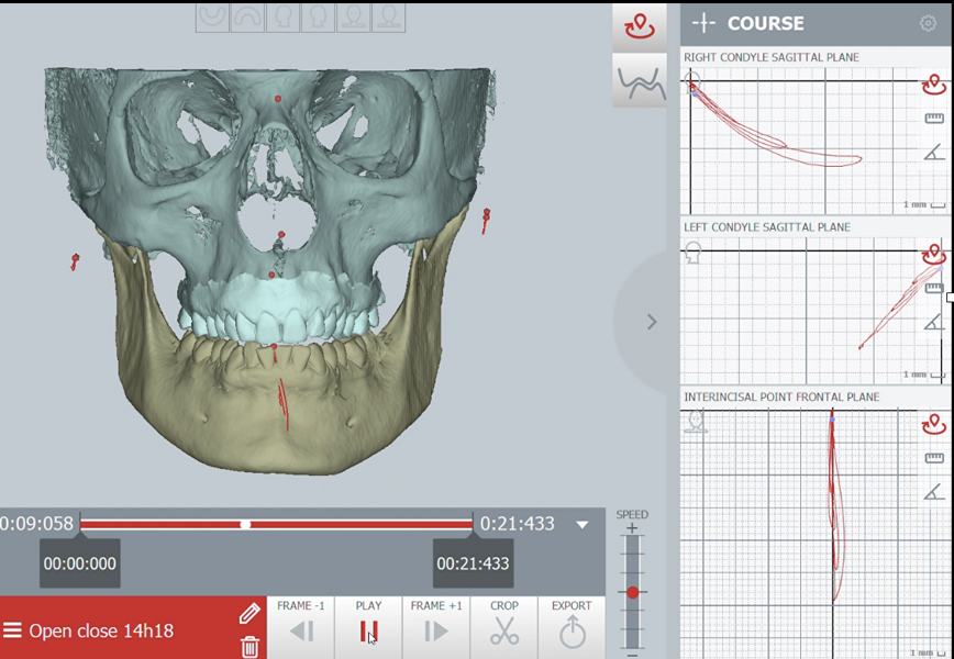 Fig. 37: Pretreatment condylar and incisor graph recordings during opening and closing.