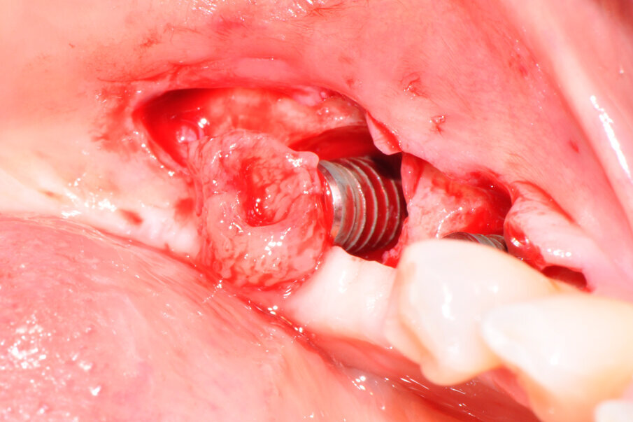 Fig. 4 – Il tessuto granulomatoso rimosso che circondava gli impianti