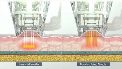 Sinergia rigenerativa in medicina estetica: RF-Needling, esosomi, peptidi  e i potenziali effetti sui telomeri