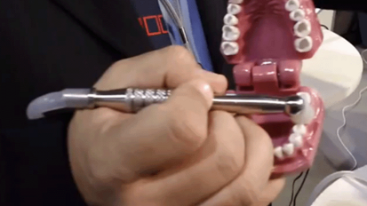 Las grandes ventajas del ozono para el tratamiento de la caries dental