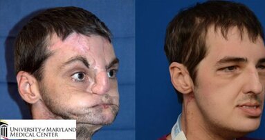 Amerikaner erhält nach Schussverletzung neues Gesicht
