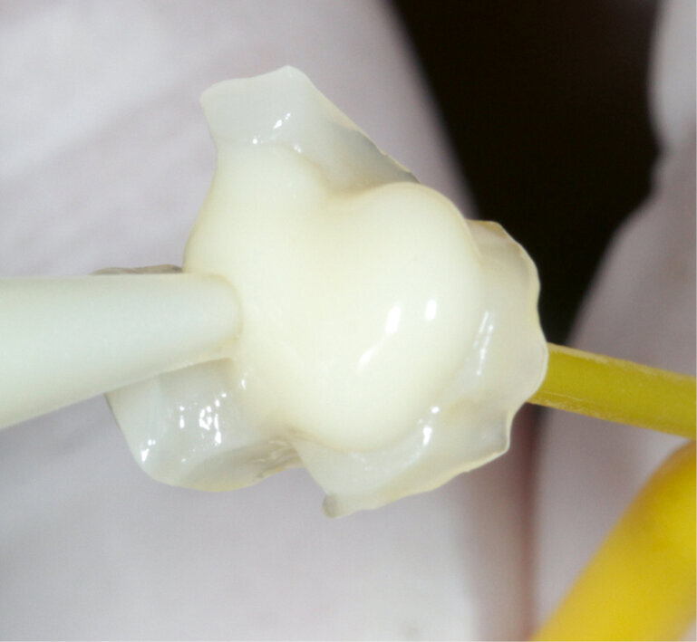 Fig. 11: Applying Variolink Esthetic luting composite to the bonding surface