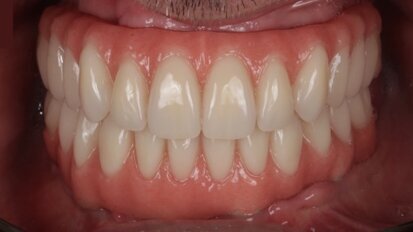 PEEK implant-supported prostheses to be discussed in webinar