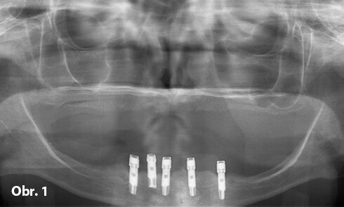Předoperační snímek pěti stěsnaných implantátů ve frontálním úseku mandibuly