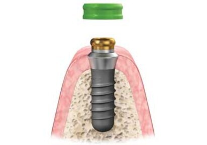 SternSnap Overdenture Implant Abutment System