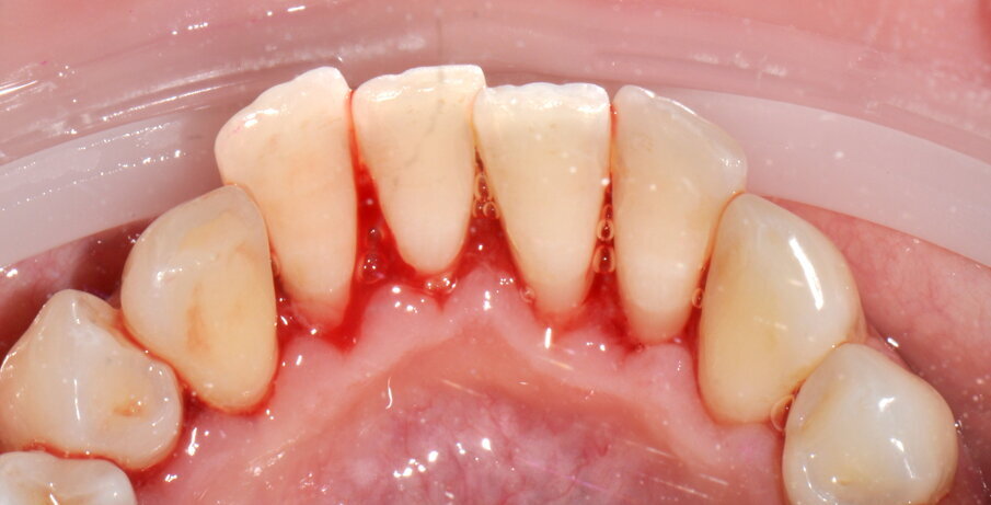 Figg. 4a-4f - Confronto fra inizio e termine della terapia. Le immagini (4a-c) mostrano le aree vestibolare palatale e linguale prima della terapia, mentre le immagini (4d-f) mostrano le aree vestibolare palatale e linguale dopo della terapia.