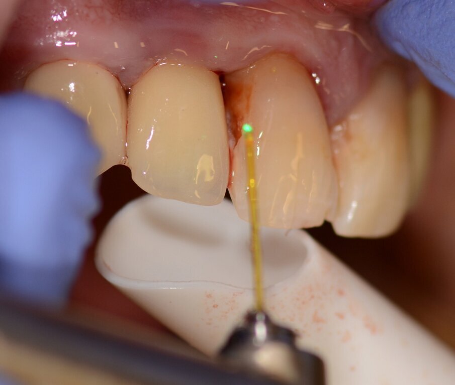 Figs. 4 & 5: Use of the Er:YAG laser Varian tip for granulation tissue removal, implant surface decontamination...