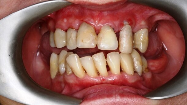 Zastosowanie lasera Er:YAG w leczeniu kieszeni przyzębnych