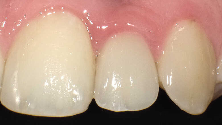 Ouverture de l’espace inter-radiculaire pour la pose d’un implant étroit