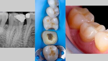 Manejo clínico de un tratamiento de conductos en 4.7