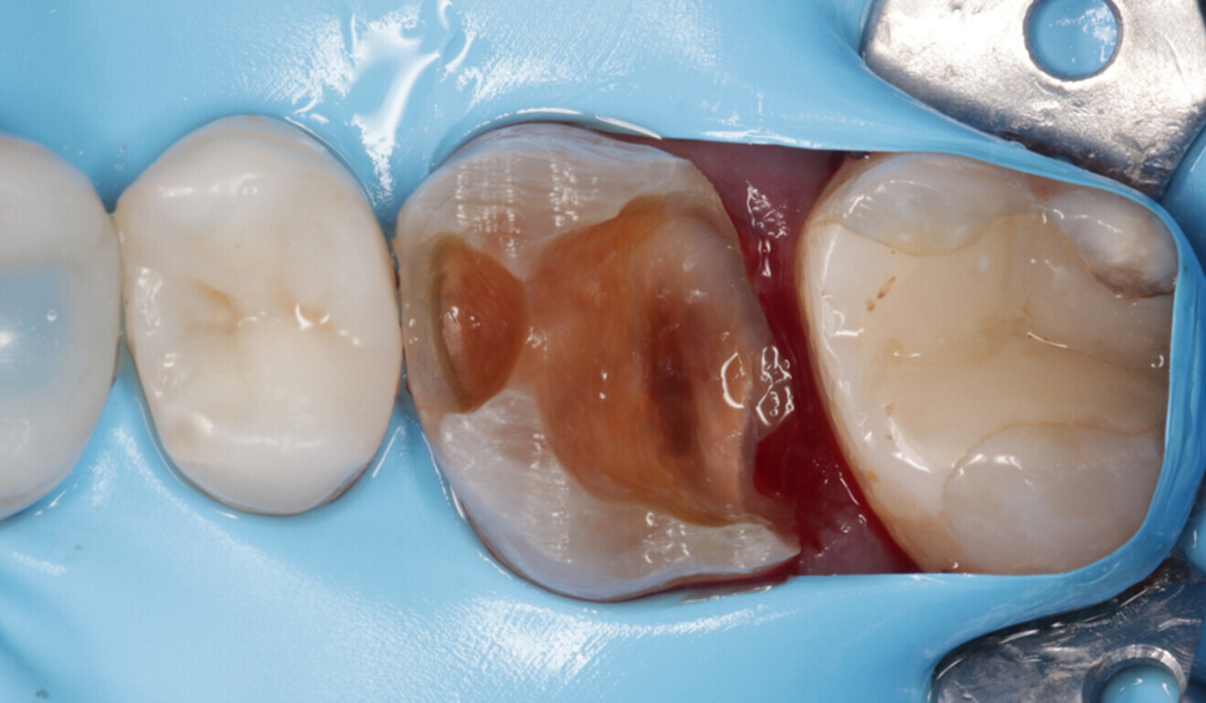 Fig. 4: Initial preparation involving reduction of the cusps and exposure of gingiva. (Image: Kuraray Noritake Dental)