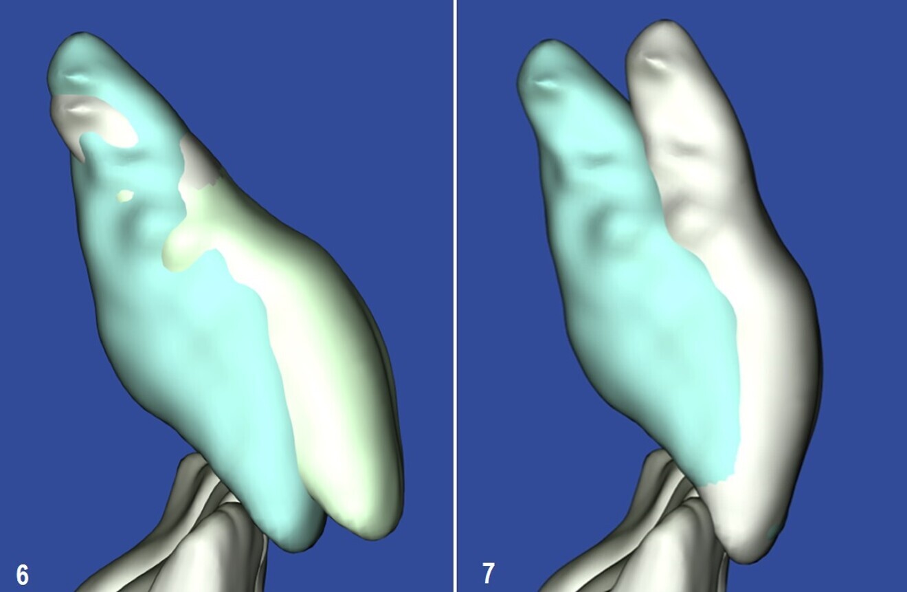 Figs. 6 & 7: SureSmile tooth movement system applied to an incisor. Blue represents the tooth position before movement is applied. Green represents the tooth position after planned movements have been fully expressed.