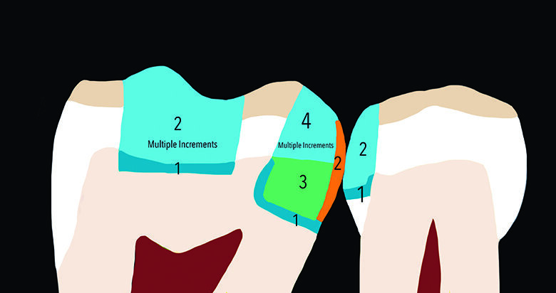 Fig. 11. Graphical representation of restorative technique with incremental layering.  