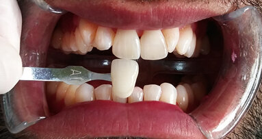 El blanqueamiento posterior a la higiene ahora es un tratamiento al alcance de todos