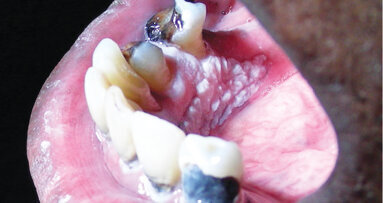 The keys to early cancer diagnosis: careful examination & timely biopsy