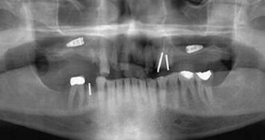 Prévention des échecs en implantologie orale