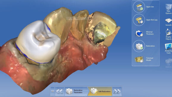 Webinar: Expert introduces design techniques for anterior restorations