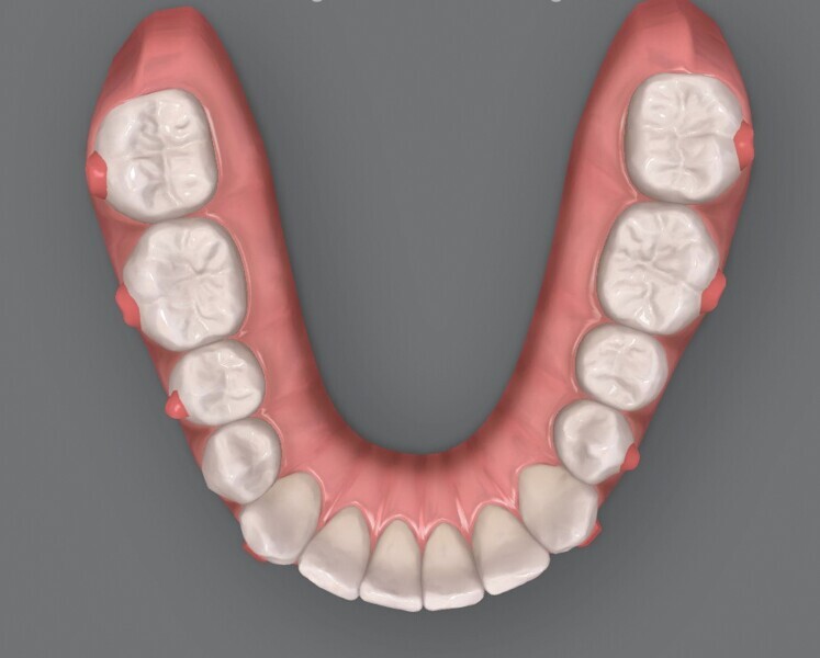Fig. 5b : Plan supplémentaire du traitement par aligneurs conçu par ClinCheck (début). 