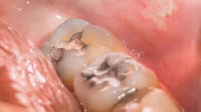 Възход и падение на живака