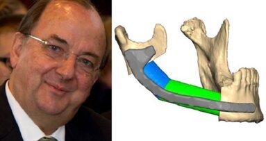 Intervista: alternative al trapianto facciale nella chirurgia orale e maxillofacciale