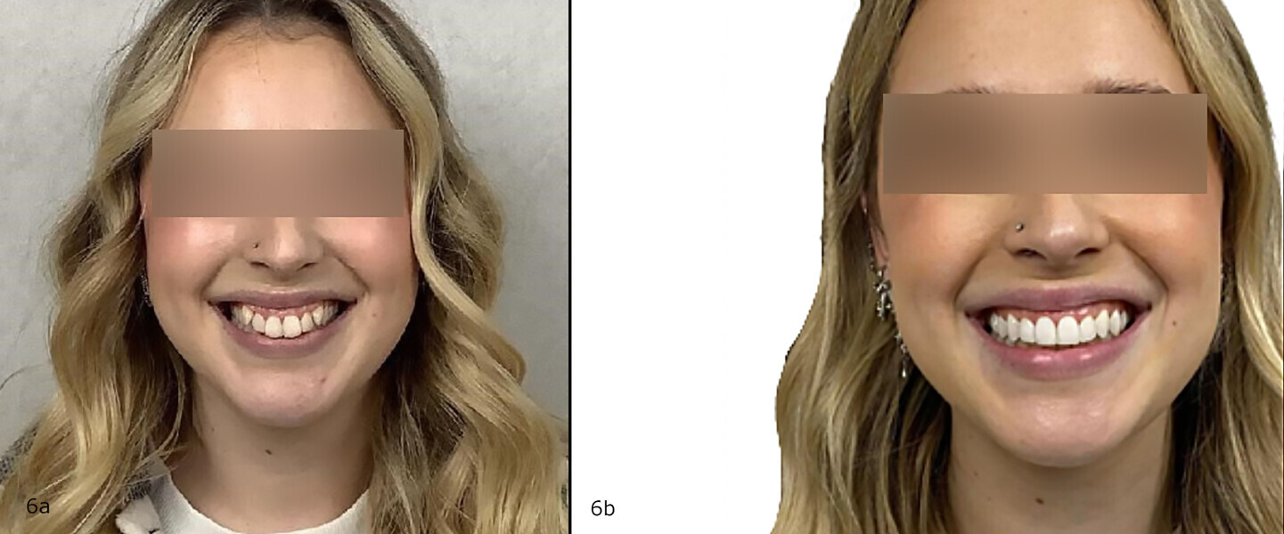 Figs. 6a & b: Before (a) and after (b), case version 2.