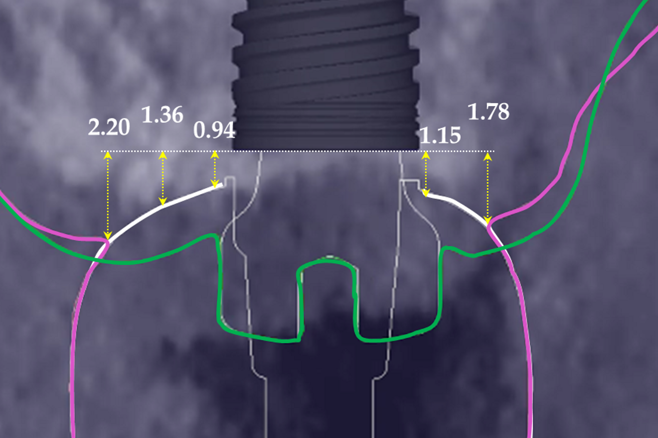 Fig. 7b: Height available for the gingiva down to the level of the neck of the implant.
