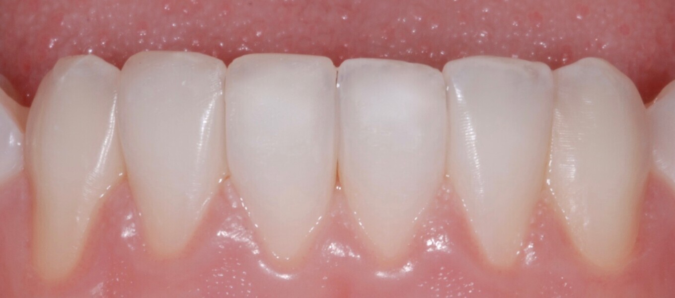 Fig. 40: Close-up intra-oral mandibular frontal view after treatment.