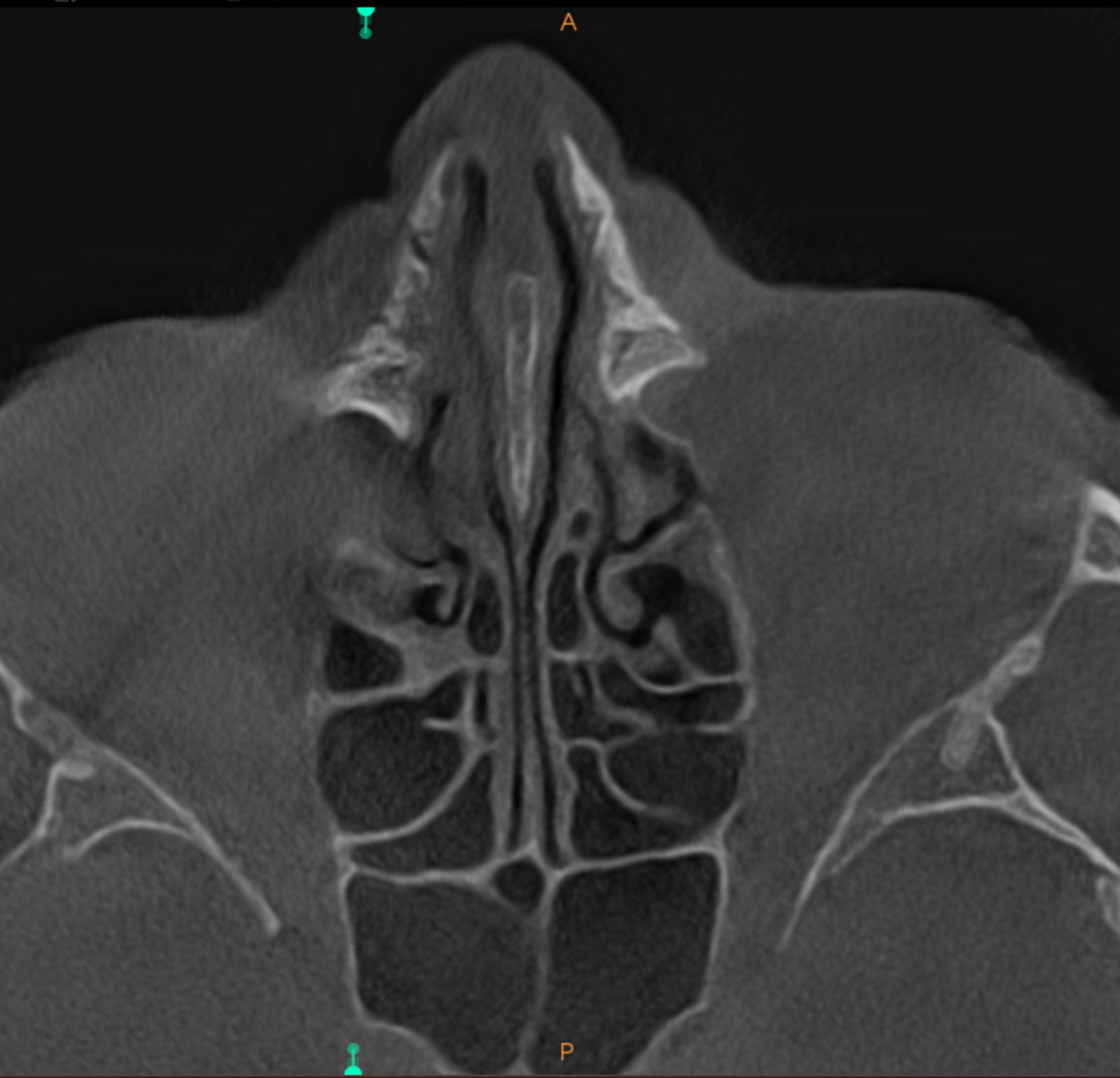 Fig. 5f: Very high-level transversal cross-section of the maxilla showing involvement of the lower part of the cavernous sinus.