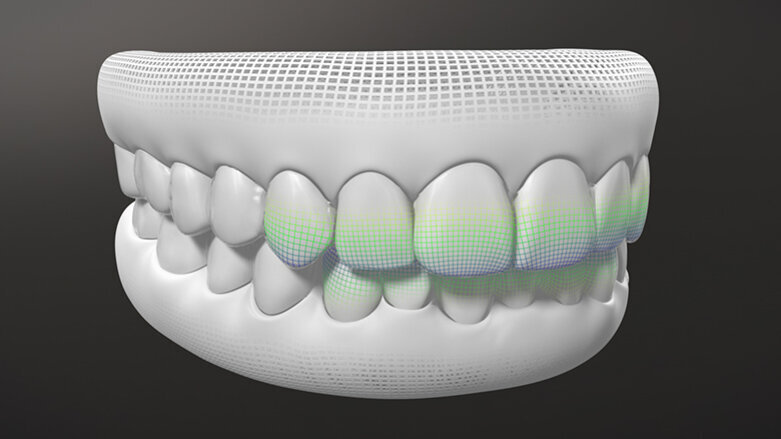 Invisalign G8, systém s novými aktivačními funkcemi SmartForce Aligner Activation