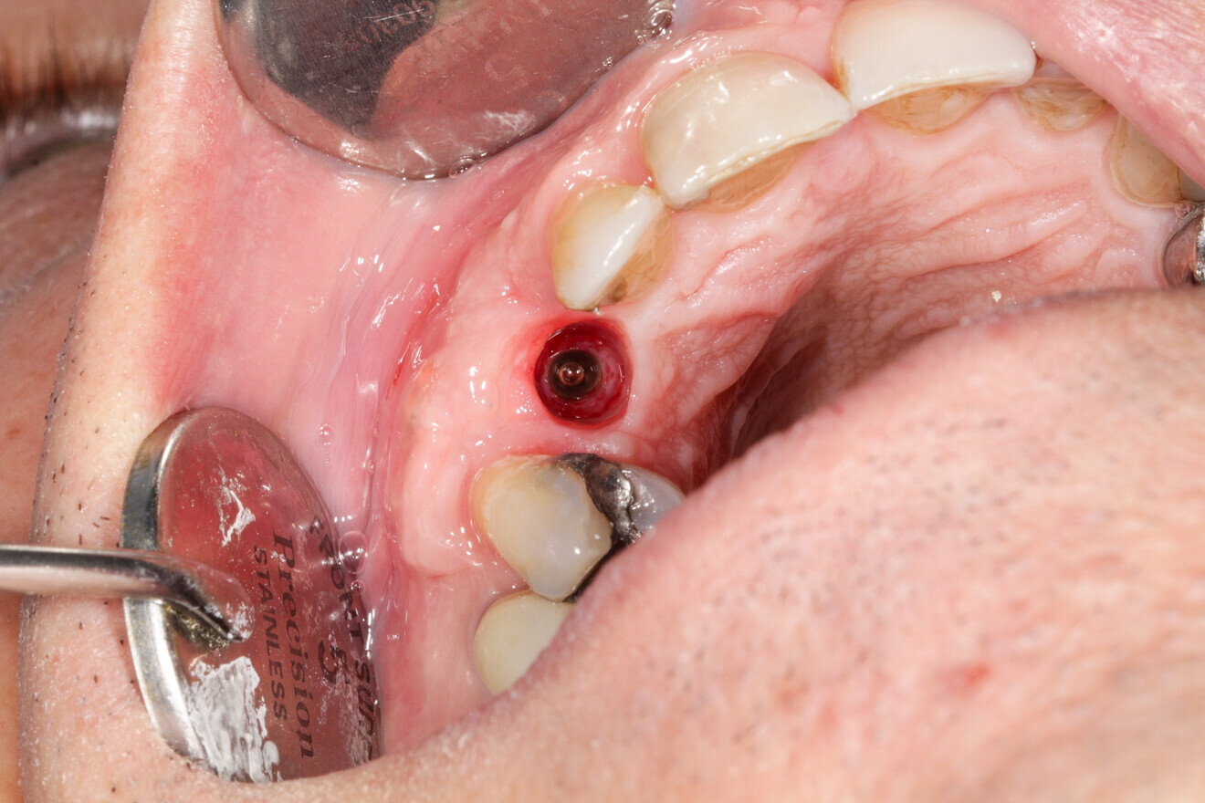 Fig. 21: Fitting of the definitive prosthesis.