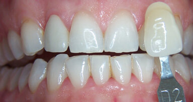 Lo sbiancamento come terapia cosmetica “strumentale”