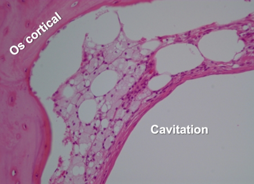 Fig. 2 : Structure histologique d’une cavitation avec espaces médullaires vides et adipocytes nécrotiques (© Dr Jerry E. Bouquot).
