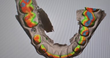 Skanowanie z poziomu implantu – część 1