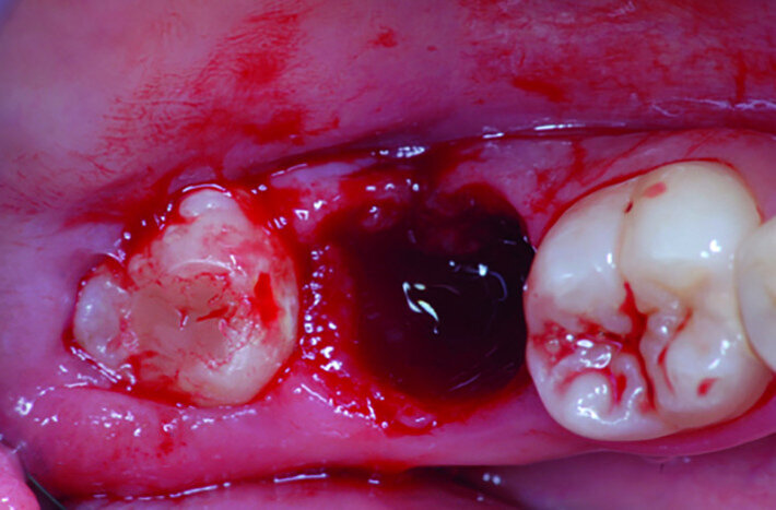 Fig. 17a: Clinical images: Extraction site of fractured tooth #47.
