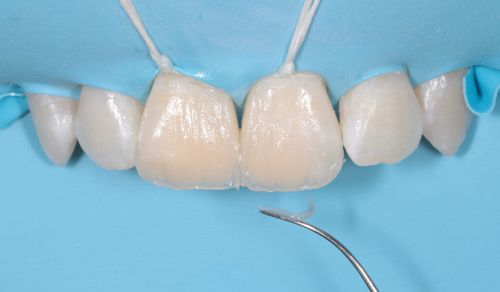 Fig. 14: Application of the Clear effect shade in the incisal area.
