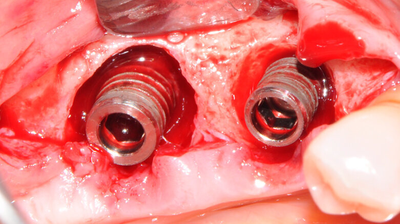 Trattamento di periimplantite: rigenerazione con l’utilizzo di un sostituto a lento riassorbimento