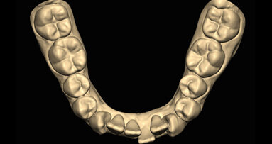 Hybridní terapie alignery