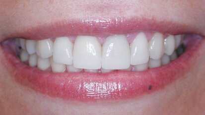 Rendre des facettes unitaires si naturelles qu'elles soient indétectables