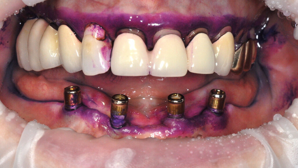 Guided Biofilm Therapy: The optimal solution for implant maintenance