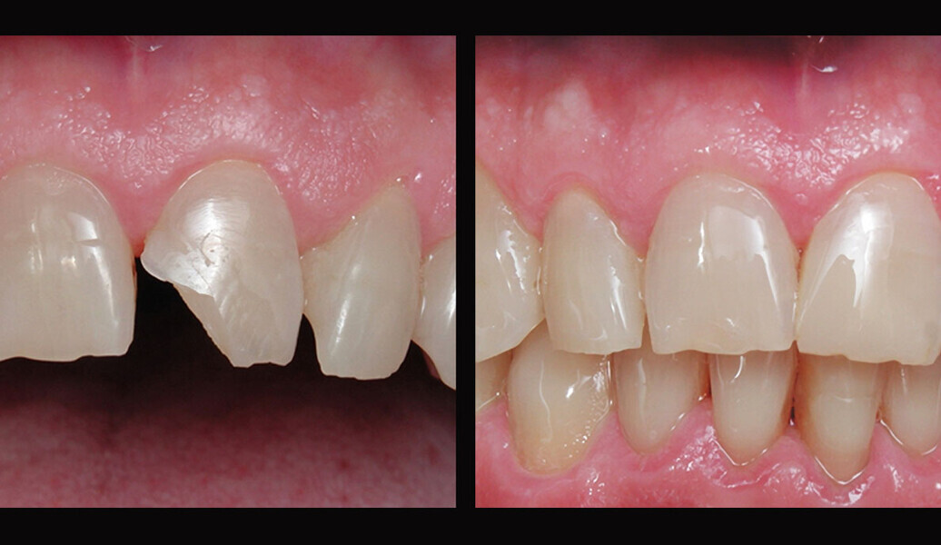Imágenes de la restauración realizada por el Dr. Joubert antes y después del procedimiento.