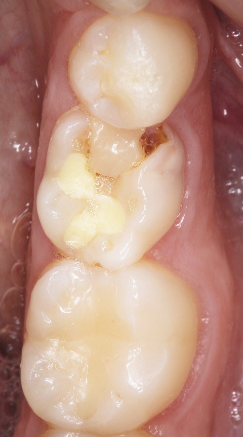 Fig. 2_Visualizzazione occlusale sx.