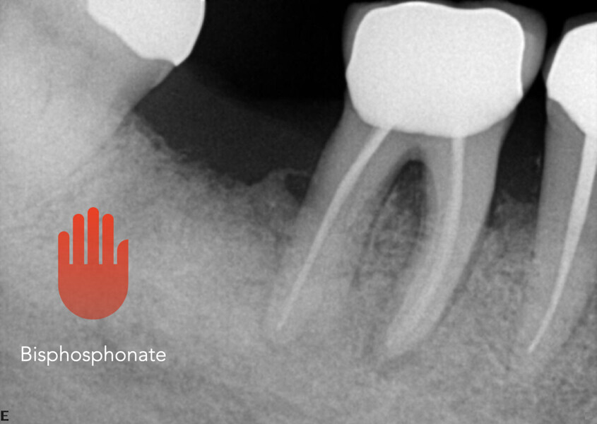 Fig. 10: Radiograph of the area demonstrating bisphosphonate associated bone necrosis.