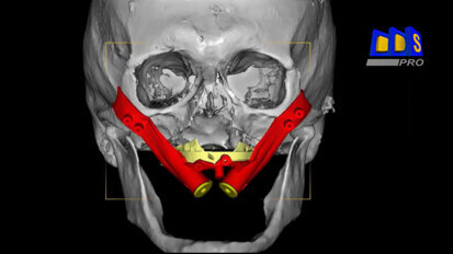 Polorto – DDS-Pro – Navigating Zygomatic Implants and Osteotomy in one Simultaneous Procedure