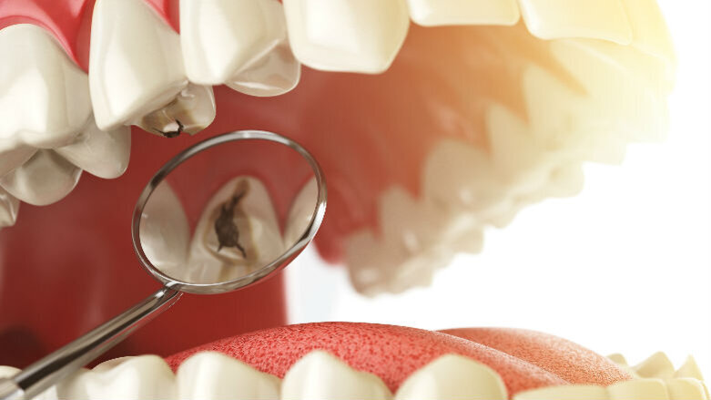 Prevenzione e management non restaurativo delle lesioni cariose