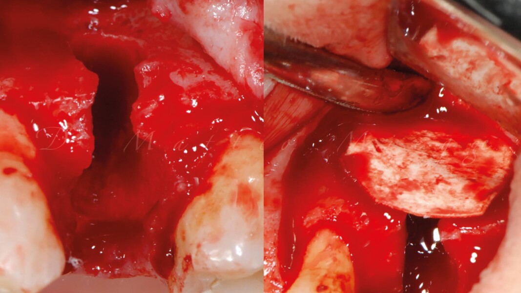 Fig. 2_Estrazione dentale e posizionamento della membrana.
