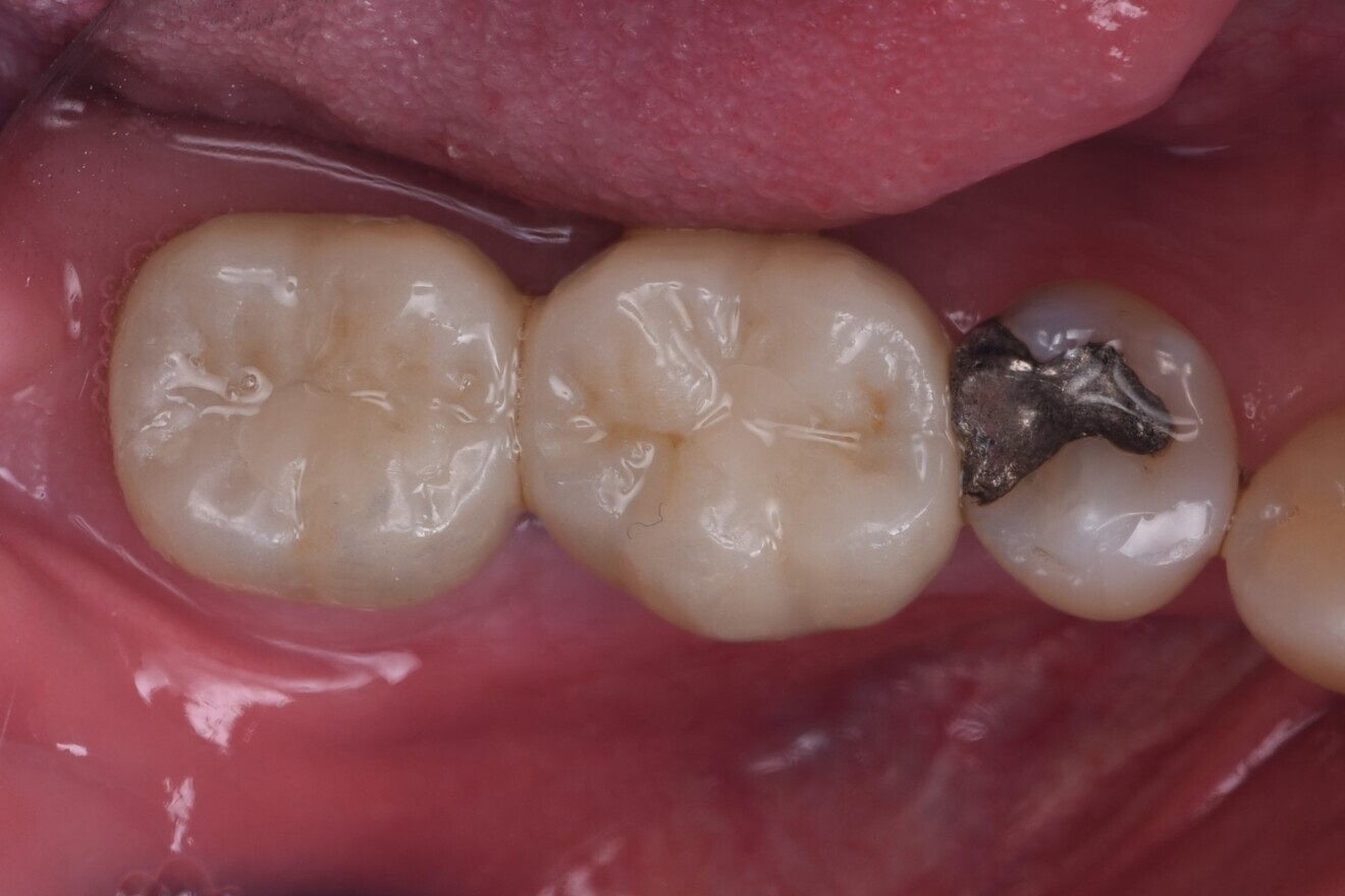 Fig. 15: Definitive zirconia crowns placed, occlusal view.