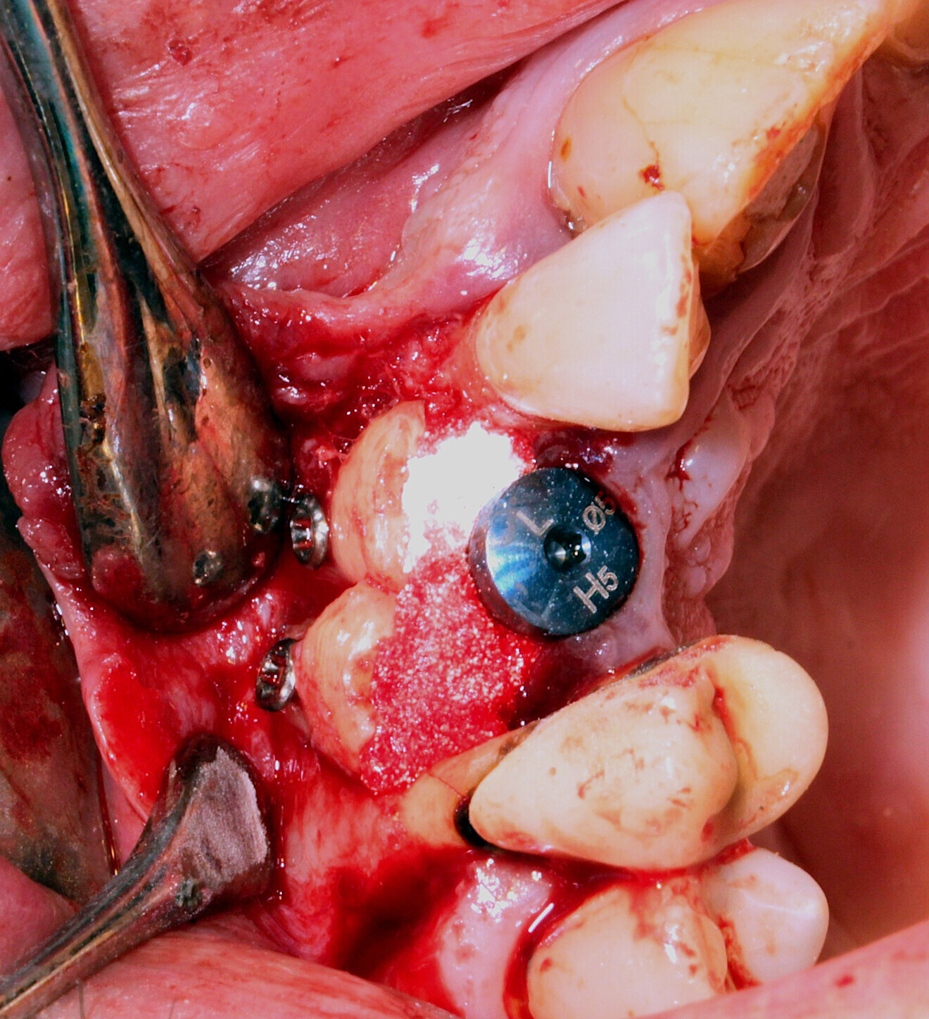 Fig. 3: Space between the graft and ridge filled with a filling material.