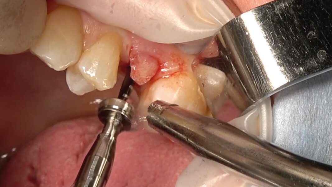 Fig. 3_Fase di preparazione implantare.